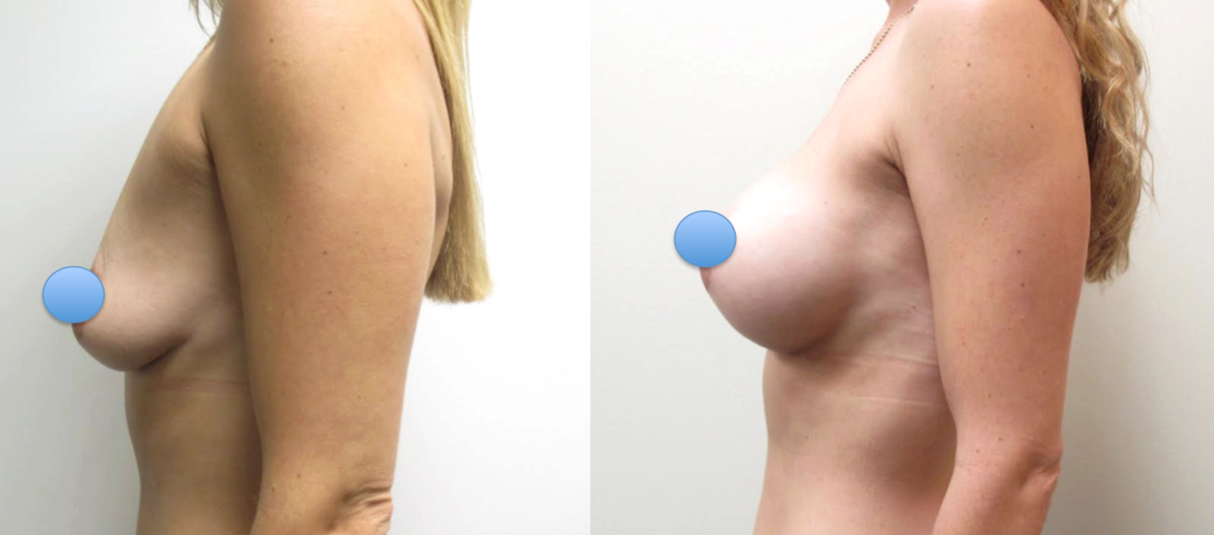 Before & After Photos of Breast Augmentation using the Dual-Plane Technique performed by Dr. Emmanuel De La Cruz. 