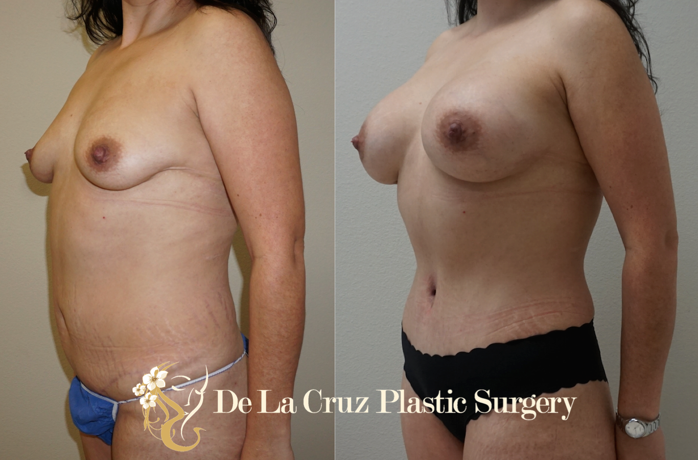 Mommy Make Over Breast Augmentation Tummy Tuck Best Plastic Surgeon.png