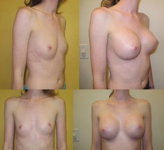 Breast augmentation with silicone implants performed by Dr. De La Cruz.
