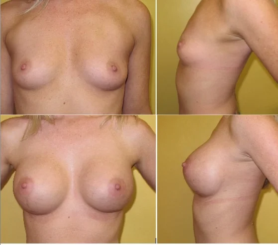 Breast augmentation with silicone implants performed by Dr. De La Cruz.