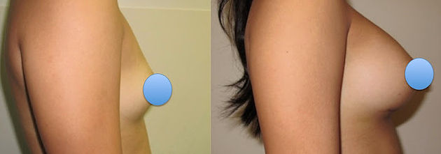  Breast augmentation with implants performed by Dr. De La Cruz. 