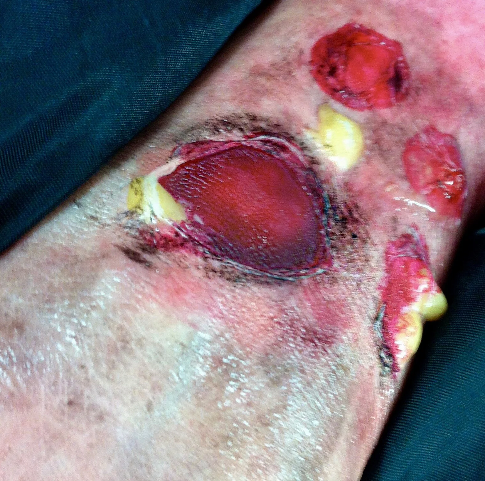  Burn spfx 