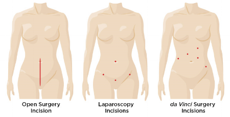 hyst_cancer_incision_comparison.png