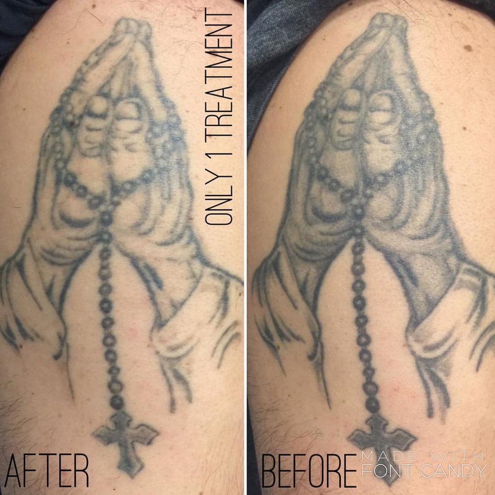 Blog — Tailored Tattoo Removal Melbourne
