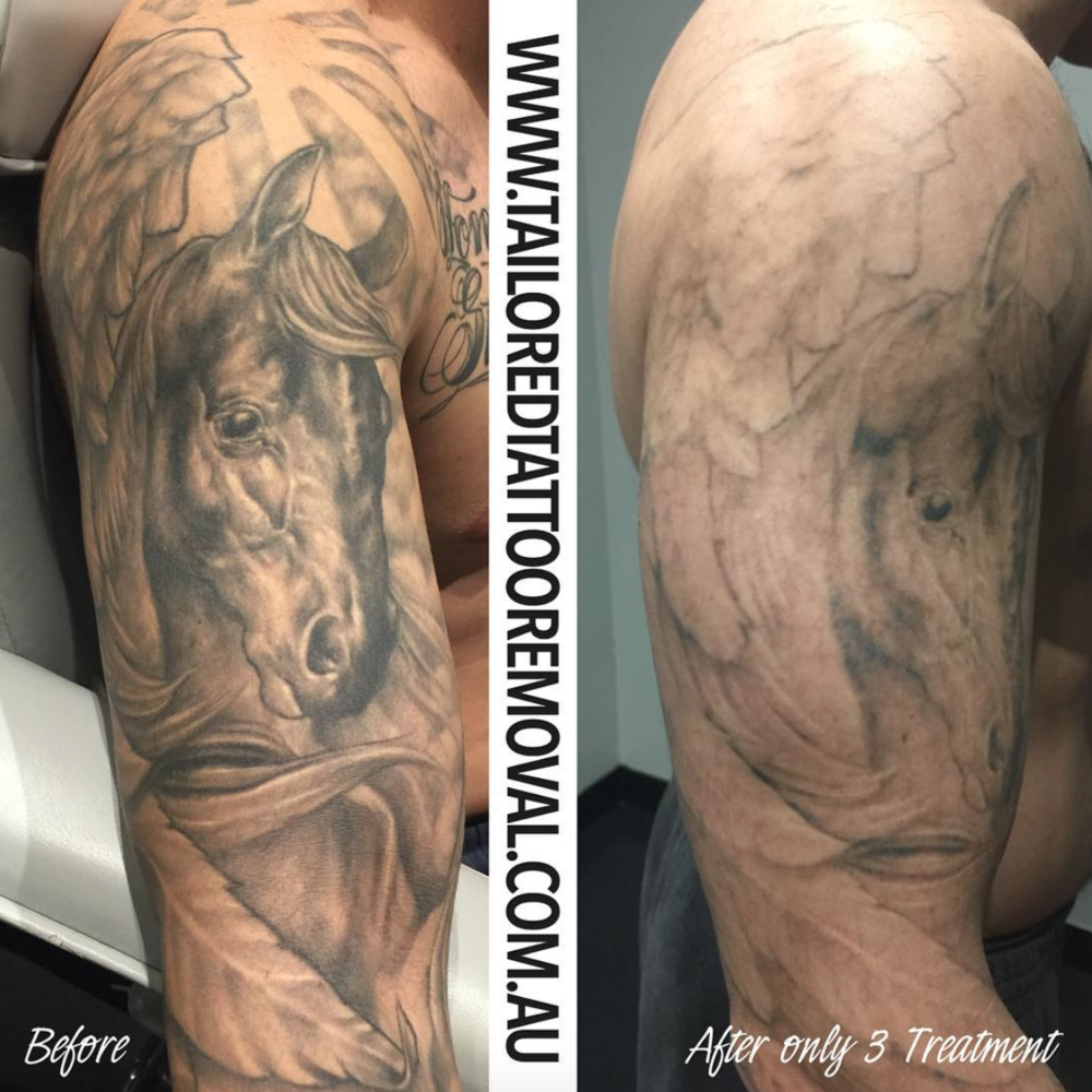 Changing the world! One bad tattoo at a time. — Tailored Tattoo Removal  Melbourne