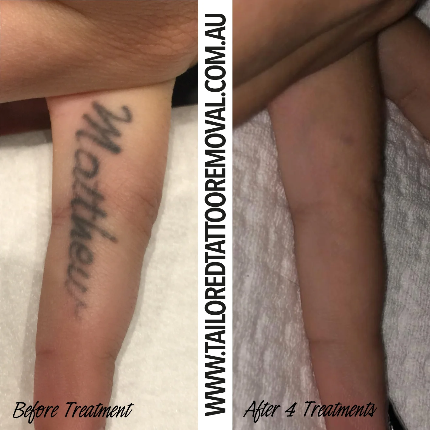 tattoo_removal_fotona-laura-finish.jpg