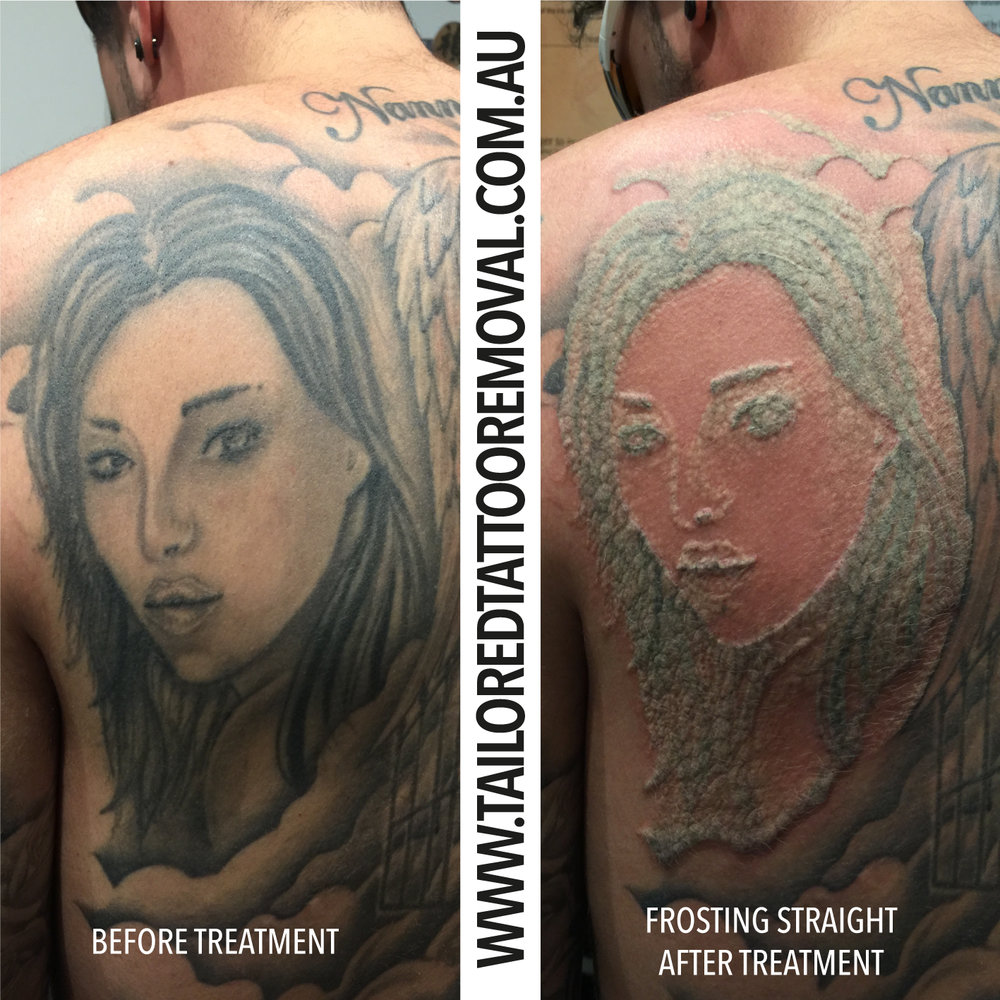 What Is Tattoo Removal Frosting? — Tailored Tattoo Removal Melbourne