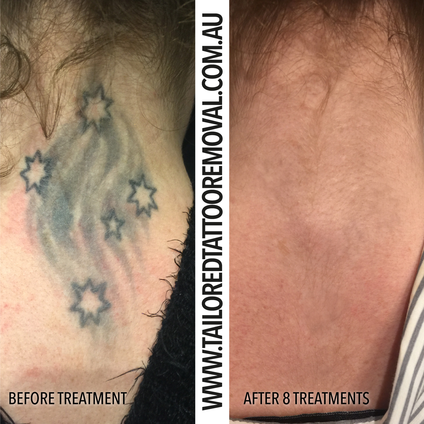 Your Tattoos Are No Longer Permanent — Tailored Tattoo Removal Melbourne