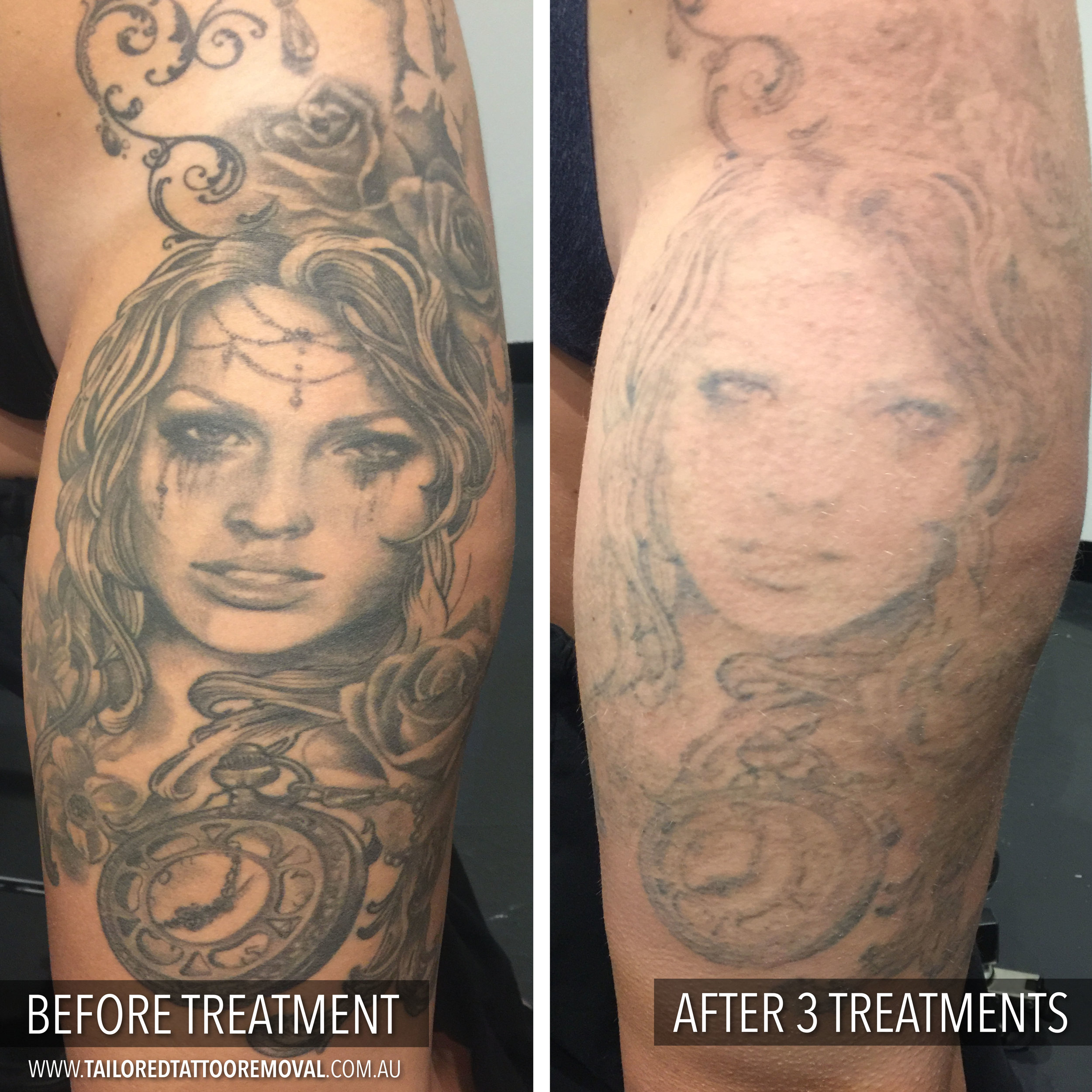 Before and Afters — Tailored Tattoo Removal Melbourne