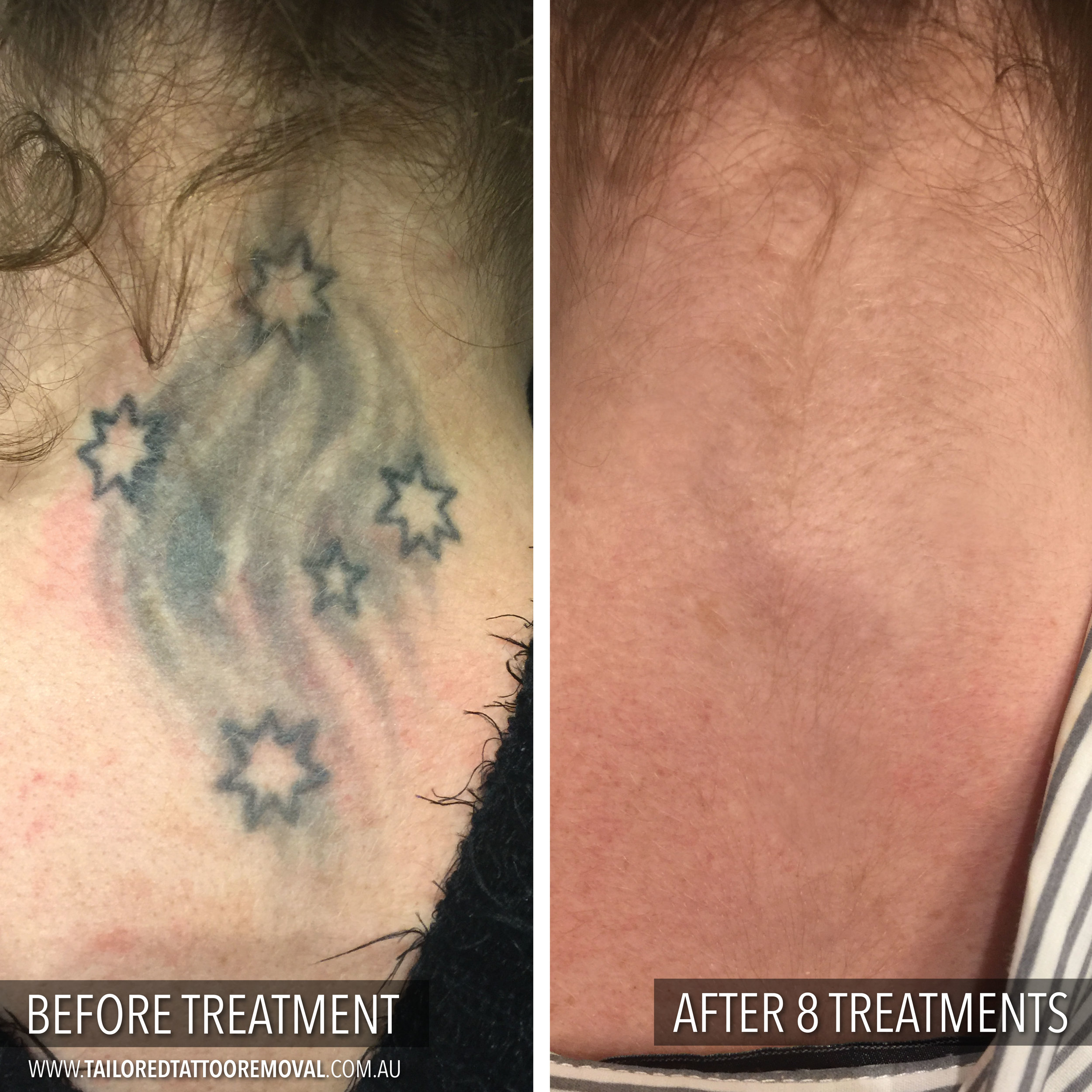 Before and Afters — Tailored Tattoo Removal Melbourne