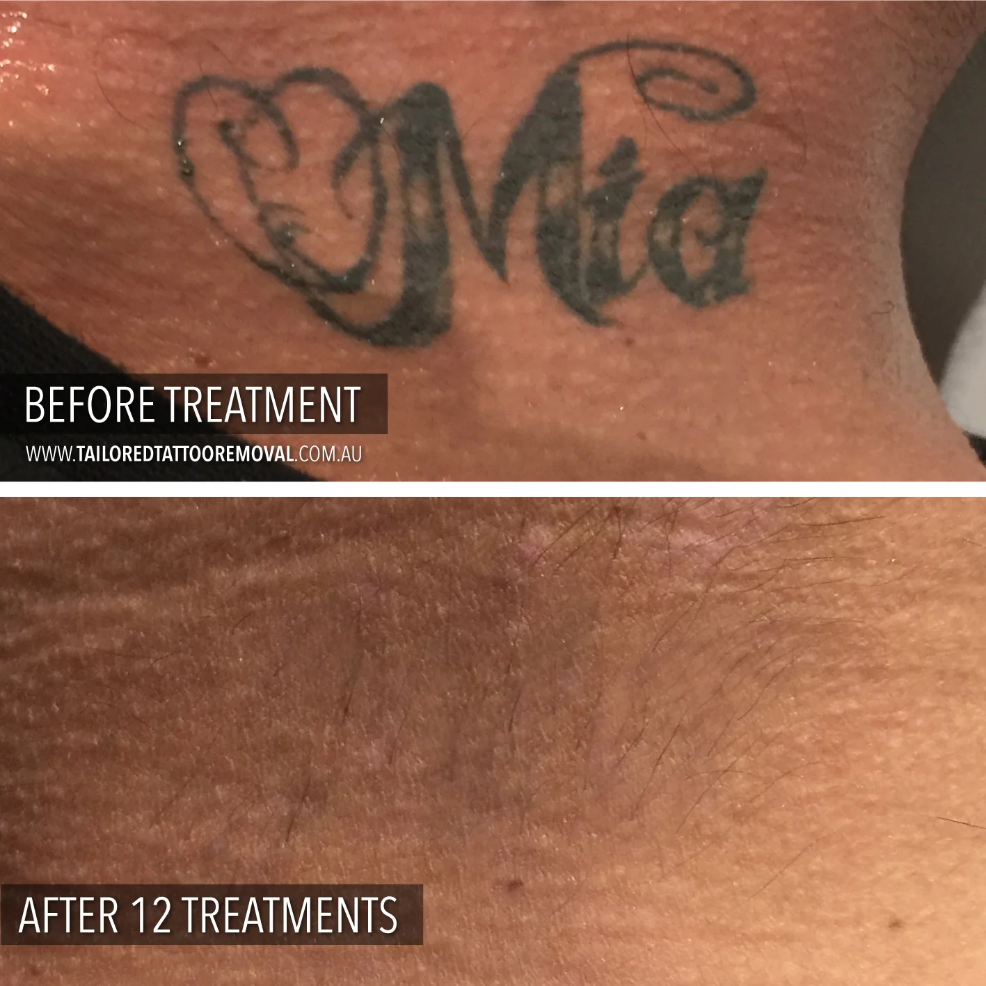 Laser Tattoo Removal | Before and After Results