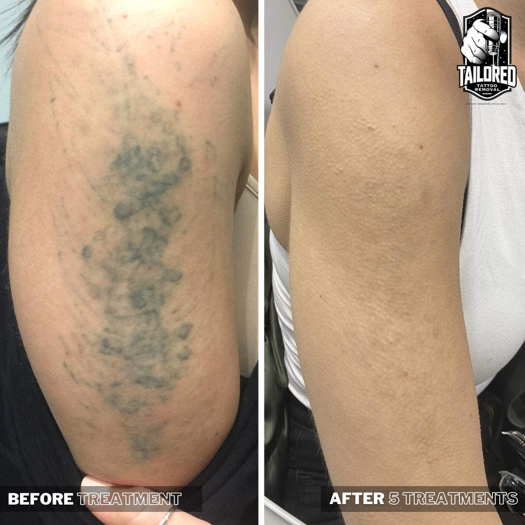 Laser Tattoo Removal Lubbock TX | Unwanted Tattoo Removal Lubbock TX
