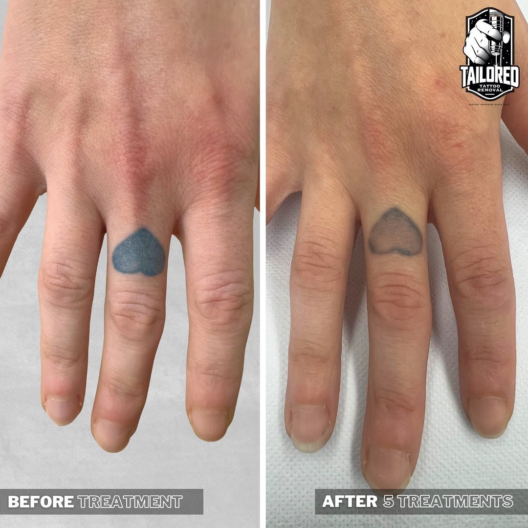 🤔Did you know&hellip;Tattoos that are furthest away from the heart such as your wrists, hands or feet will likely take longer to break down due to less blood circulation in those areas.

Generally, areas with more fat and blood flow, like your arms 