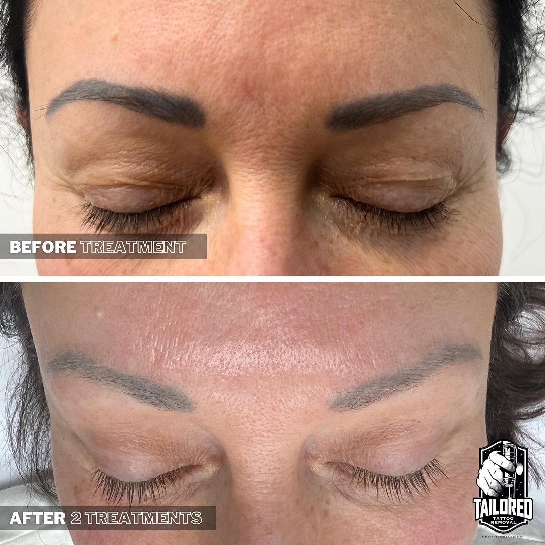 Stop and admire this amazing brow transformation for a moment!😍 

We work with some great cosmetic tattoo artists as you can tell. Our client needed her eyebrows removed before she could get them re done. We ended up completing a total of three sess