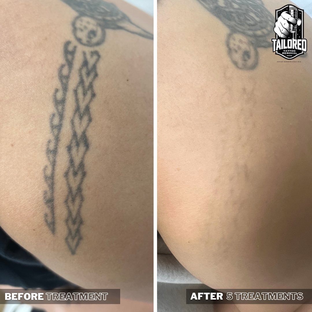 If you only need part of your tattoo removed, this is for you!

Did you know we&rsquo;re that precise with our tattoo removal laser we can remove something as small as a single number from your tattoo and not effect the surrounding areas! 😲🙌🏼

Sen