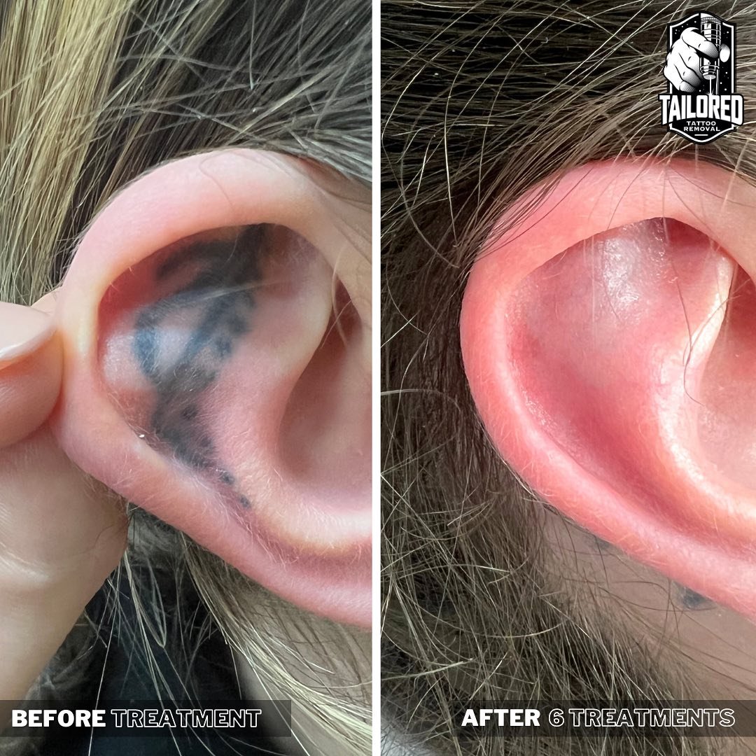 We always forget that our client&rsquo;s can&rsquo;t hear us talk during their treatment when we remove tattoos from the inside of their ear! 🤣🫠 Damn cool air machine! Haha

Send us a dm to learn more about how we can help you with a tattoo you no 