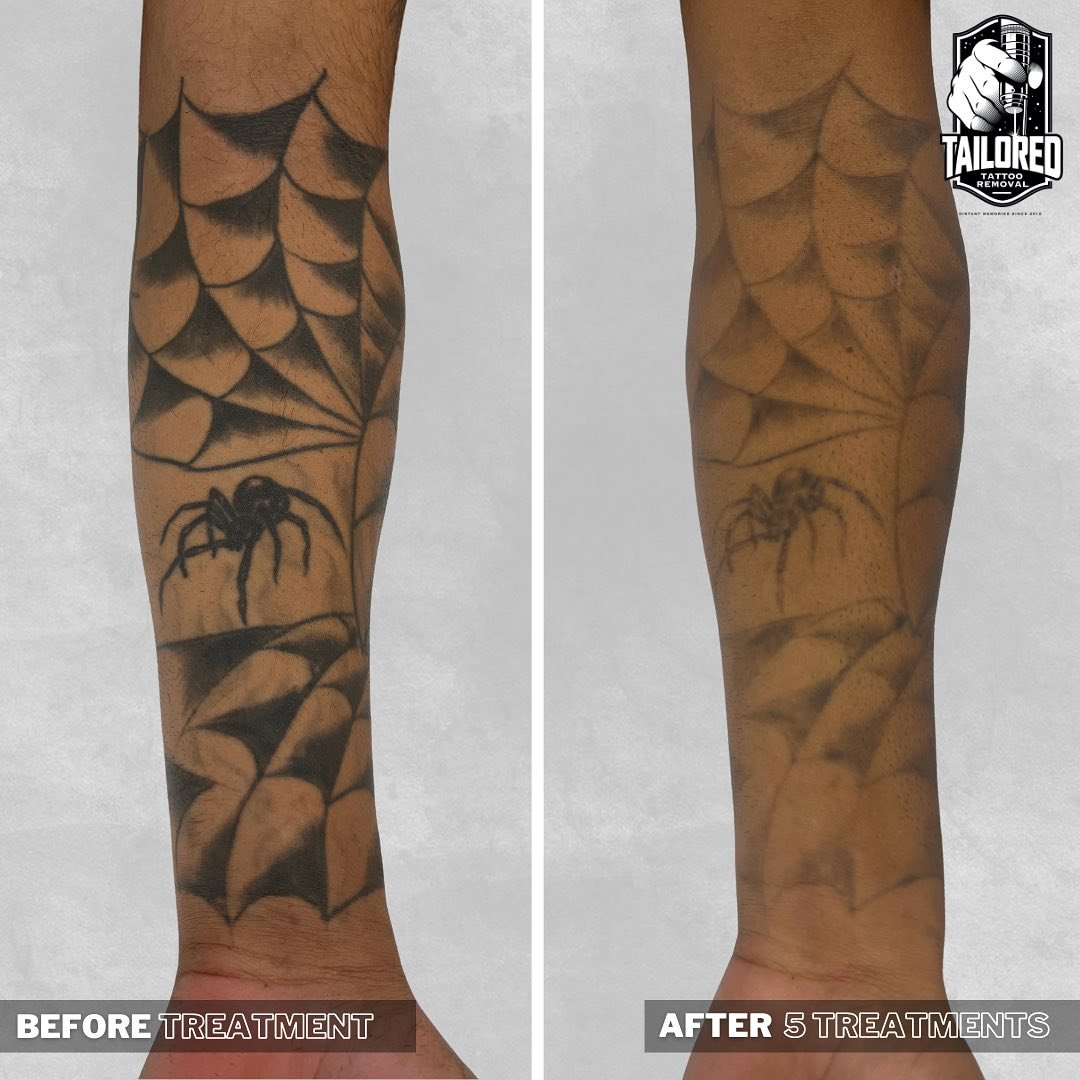 How do you feel about waking up every morning and seeing a spider on your arm?
🕷️🫣

Those bad choices we made as teens don&rsquo;t have to live with us forever. Lightening this one for an EPIC cover up! 

Our expert team is here to erase the past a