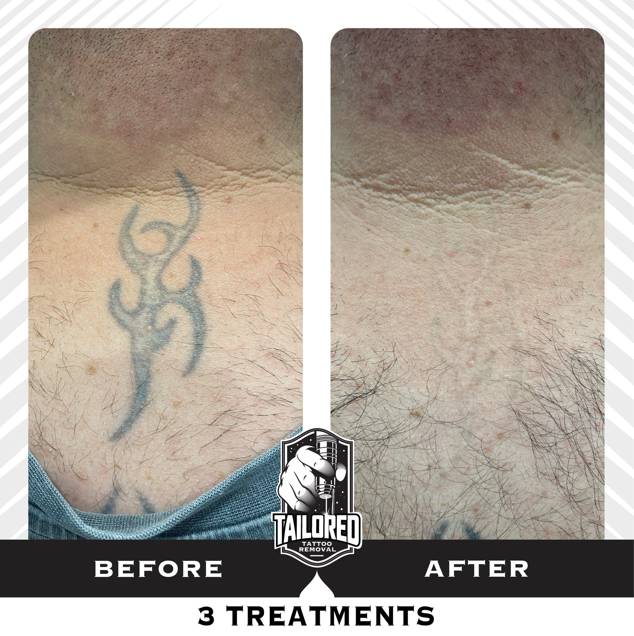 Our laser performs miracles! Don&rsquo;t live with a tattoo you no longer love. Start your tattoo removal journey with us @tailoredtattooremoval

Book in a FREE Consultation to find out more👇🏼

ᴄᴏɴᴛᴀᴄᴛ ᴜs ⚡️
📞 0413 488 789
📧 info@tailoredtattoore