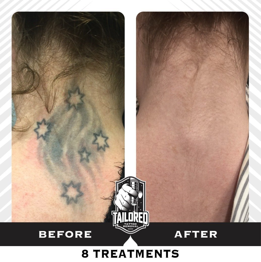 ✨ Witness the magic of our laser technology! ✨ Say goodbye to tattoos that no longer represent your journey. Dive into a new beginning with @tailoredtattooremoval and let us guide you towards clear skin. 🚀 

Embark on your tattoo removal adventure w