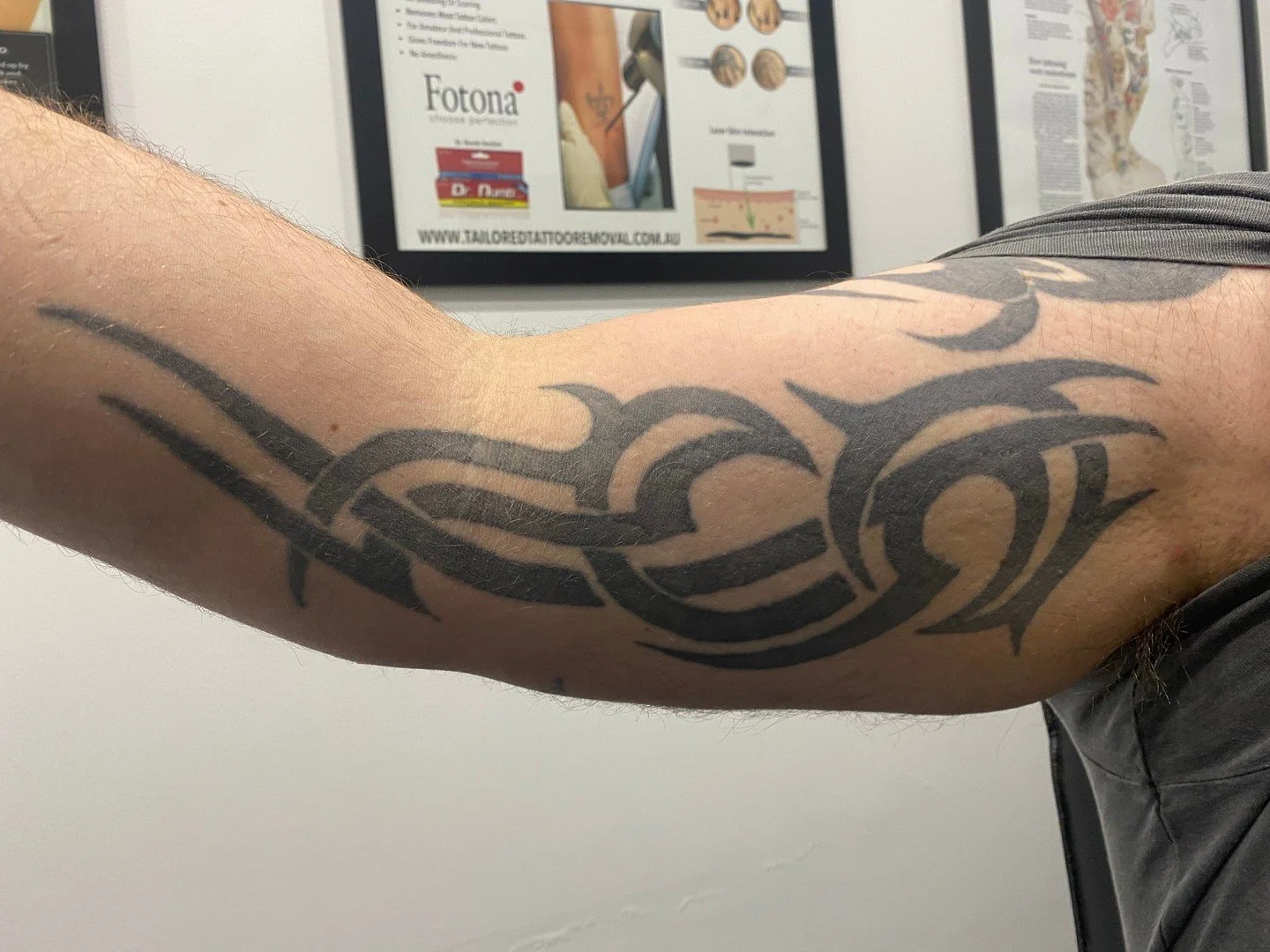 Michael&rsquo;s journey so far 👀⚡️

Swipe through:
 1️⃣ Before treatment
 2️⃣ After 2 sessions
 3️⃣ After 4 sessions
 4️⃣ After 6 sessions

This is what real, consistent progress looks like. Session by session, the ink breaks down and fades, no shor