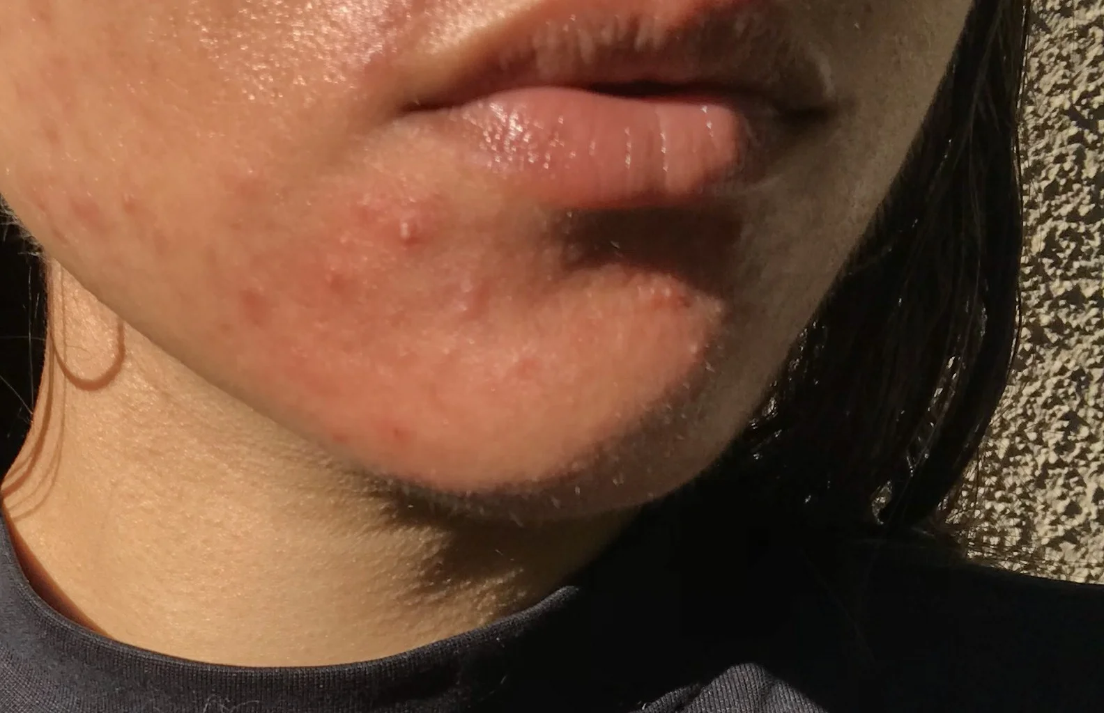 How I Healed Perioral Dermatitis in