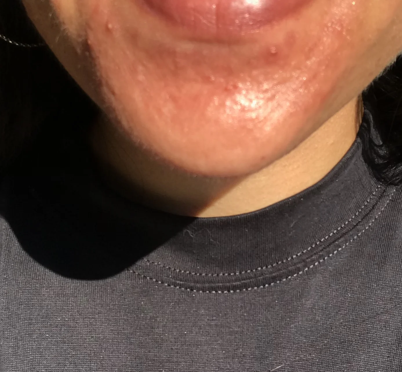How I Healed Perioral Dermatitis in
