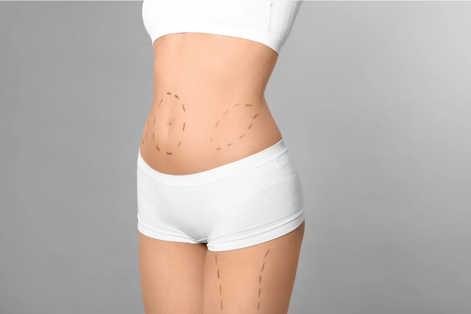 How to Prepare for Liposuction and Plan Your Recovery