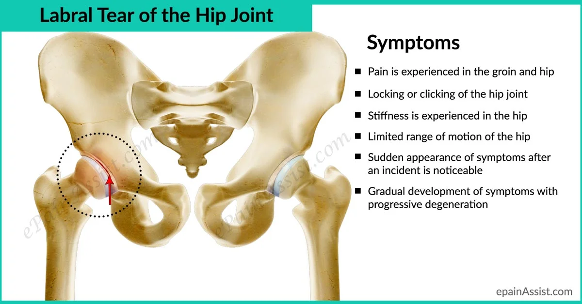 Labral-Tear-of-the-Hip-Joint.jpg