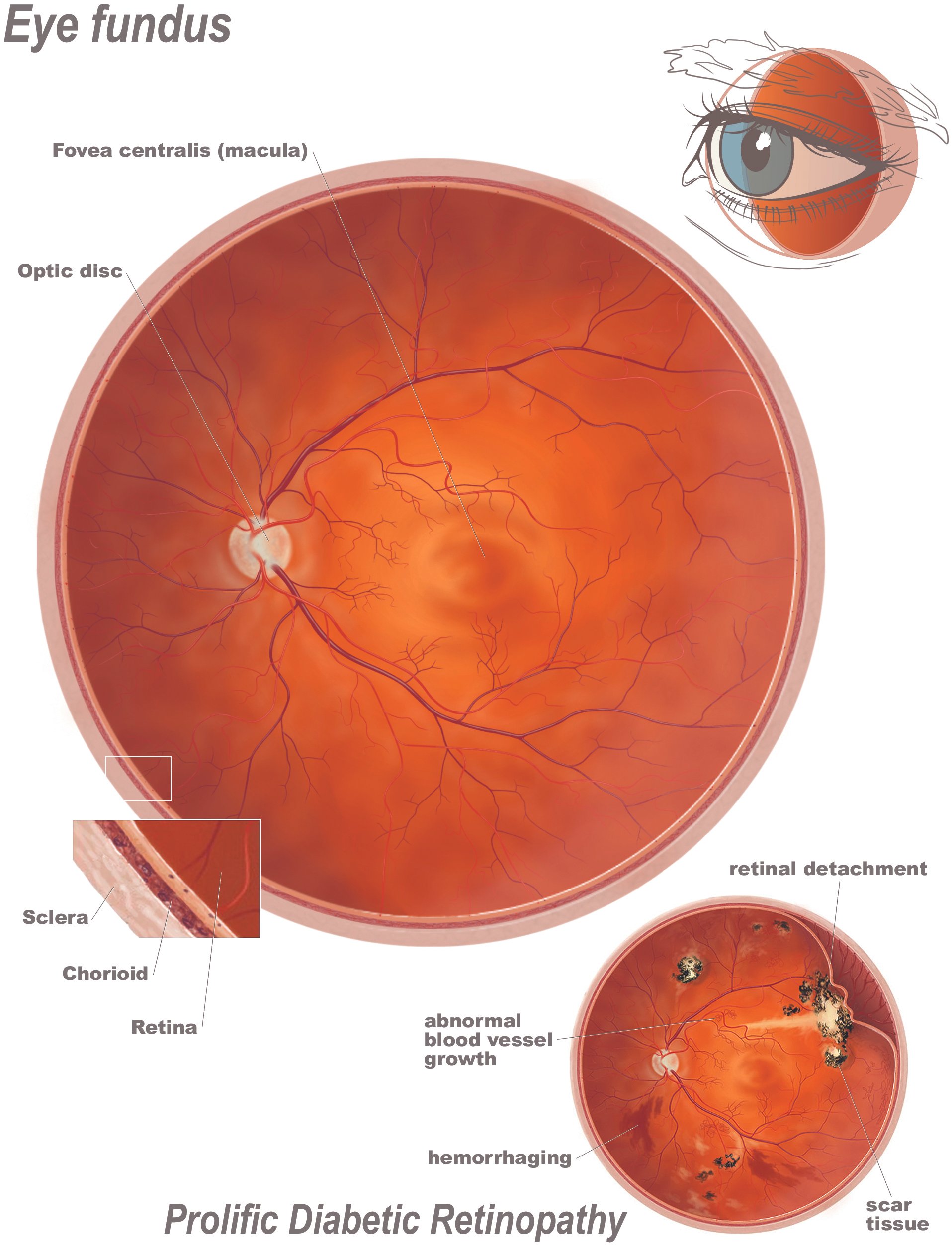 eye_fundus_pdr.jpg