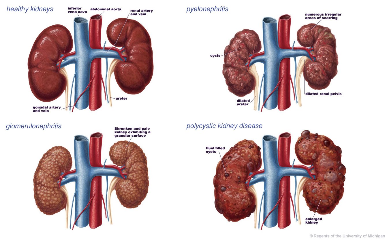 Human kidneys, healthy and diseased