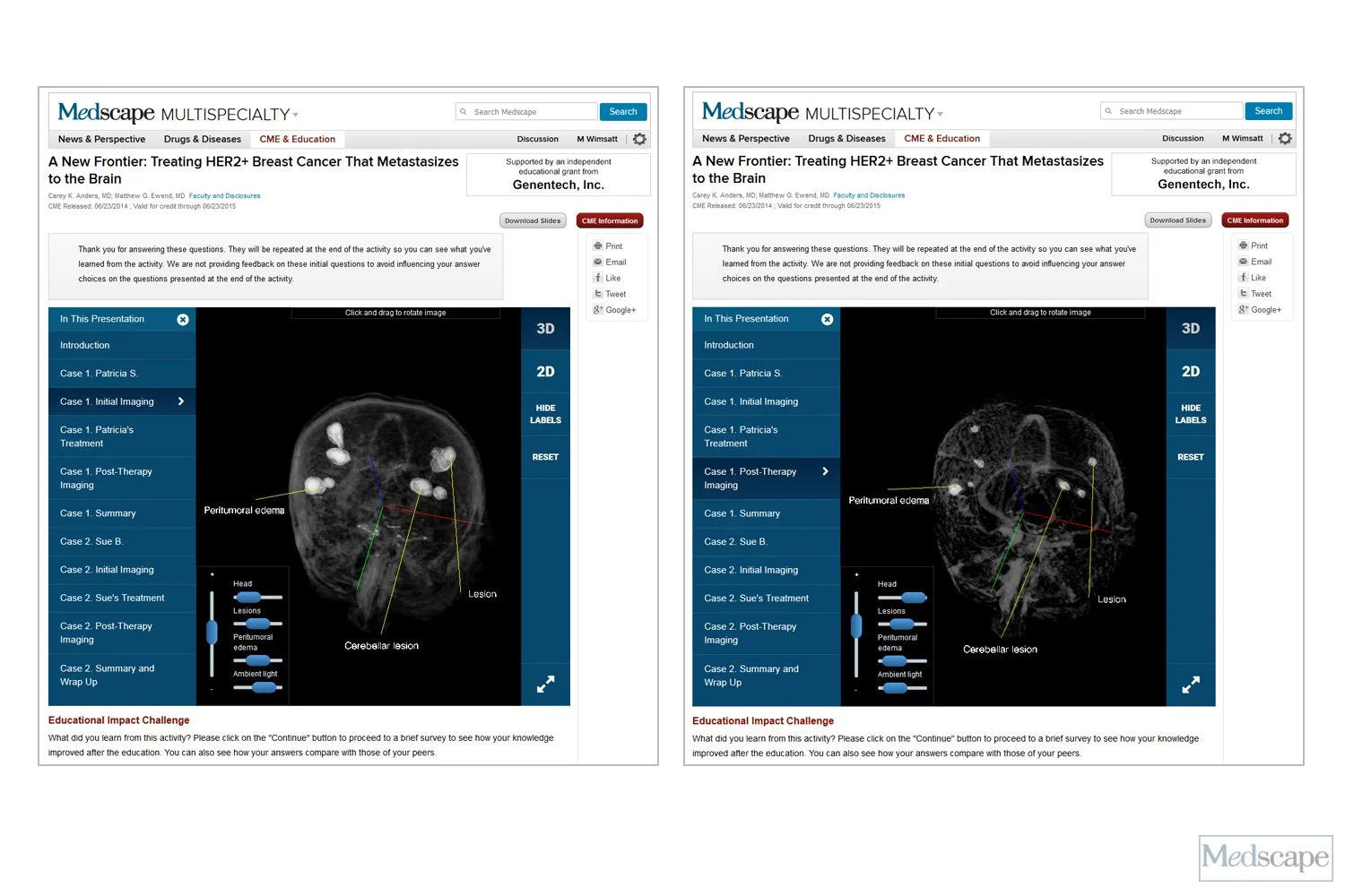 CME web module, Breast Cancer
