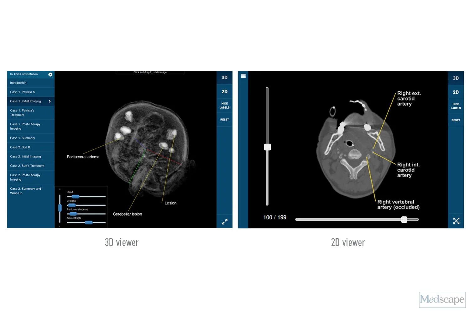 CME web module, Breast Cancer