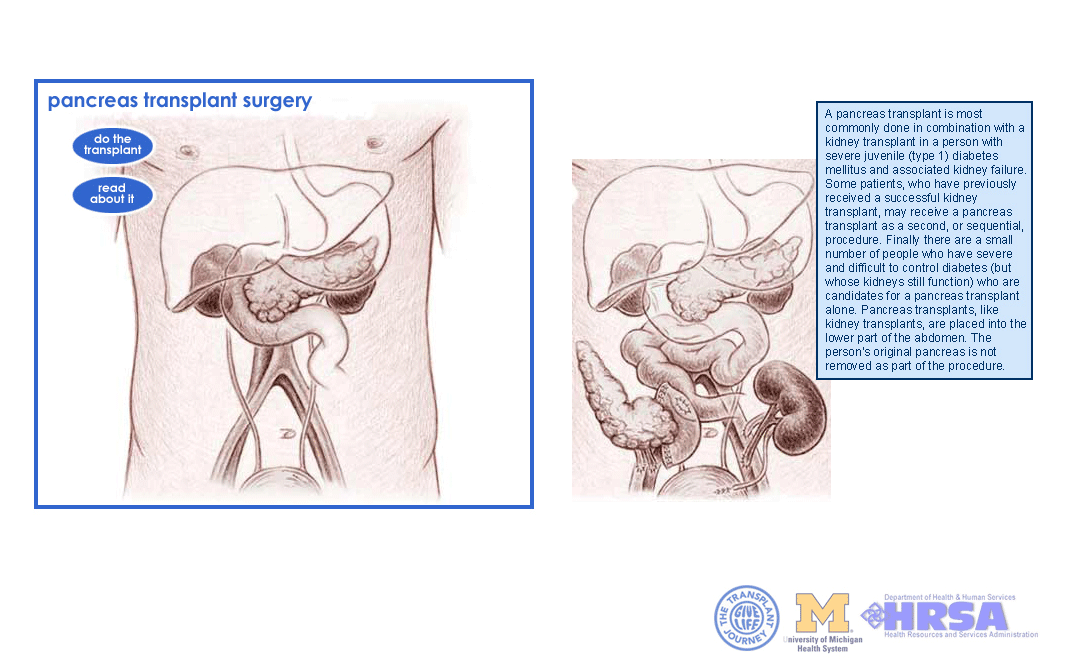 Pancreas transplant interactive pages