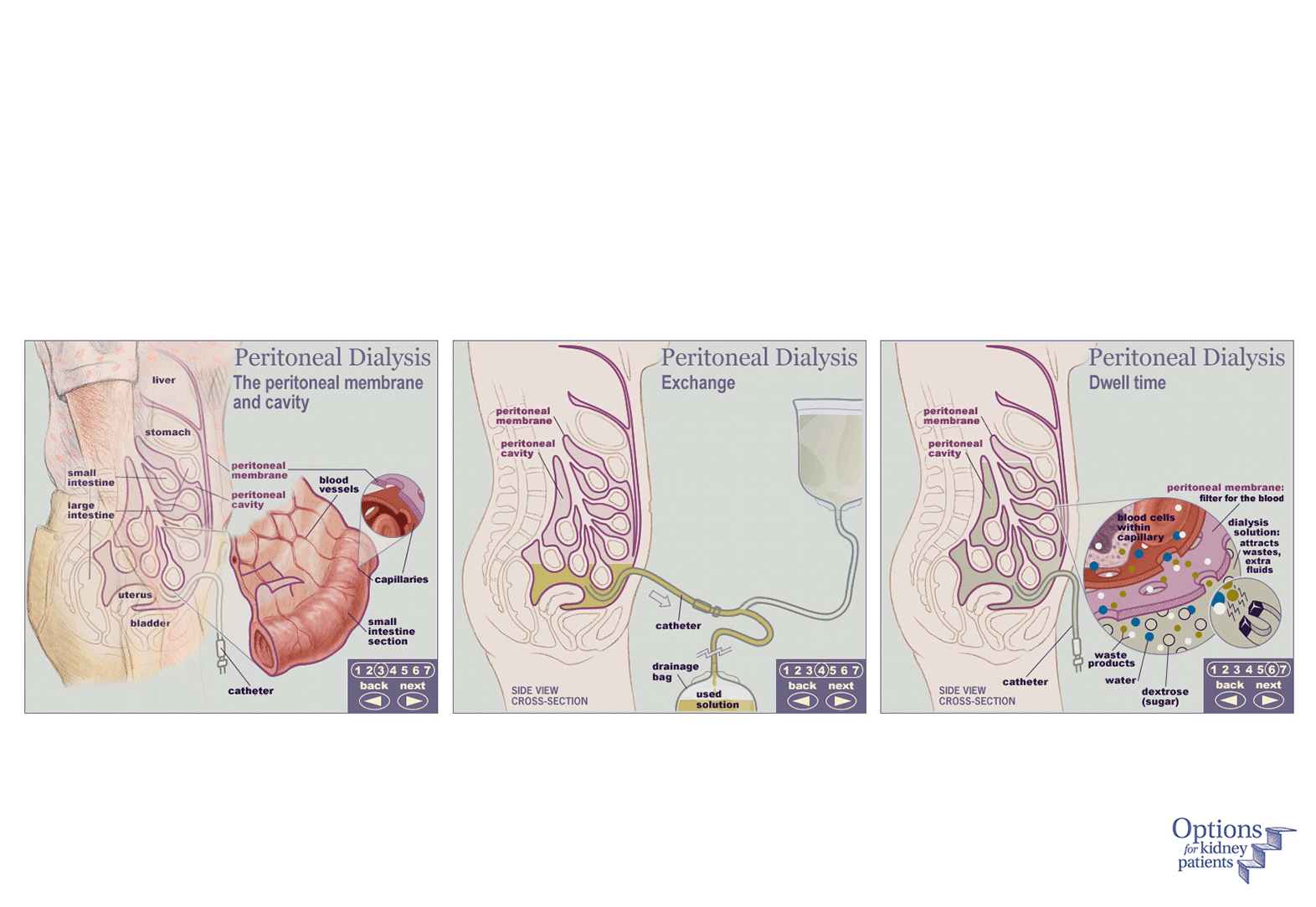 Peritoneal dialysis interactive pages