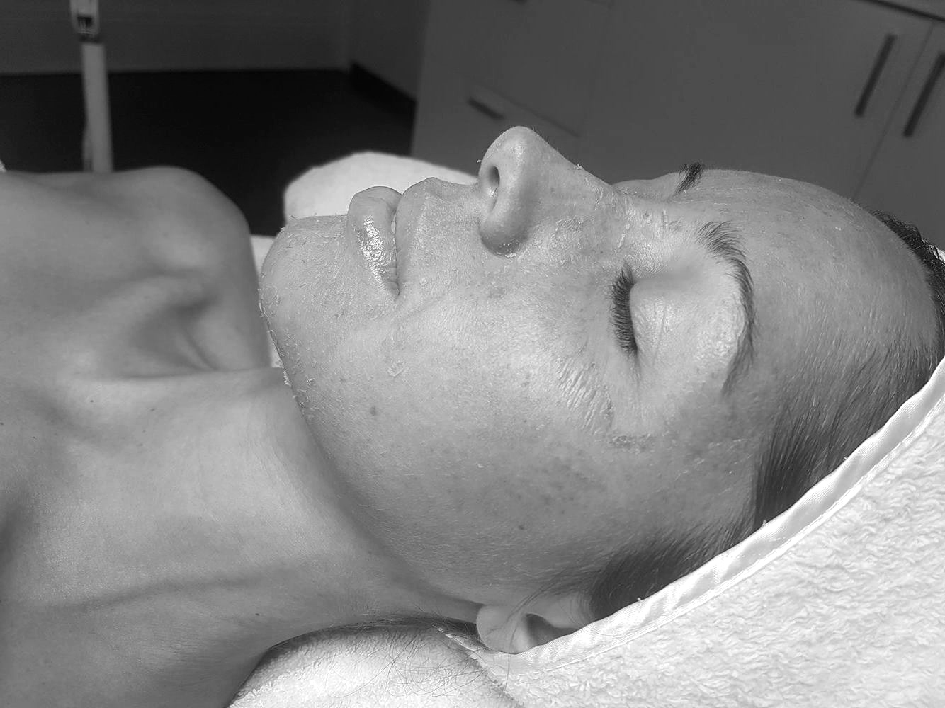 Mid way peeling before Enzyme Mask