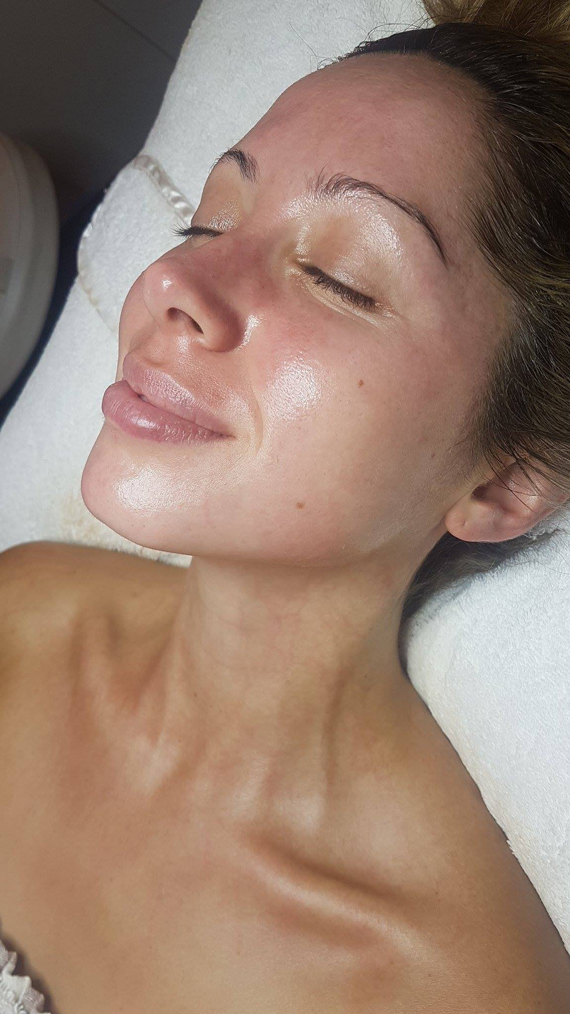 DAY 10 POST ENZYME TREATMENT
