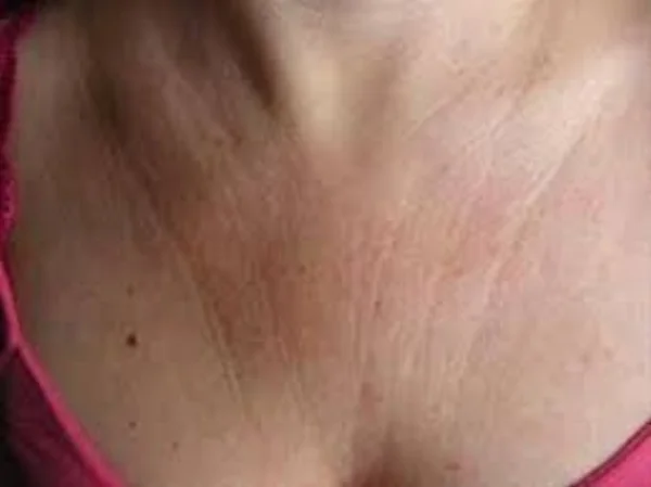 sundamage and loss of elatin on decollete