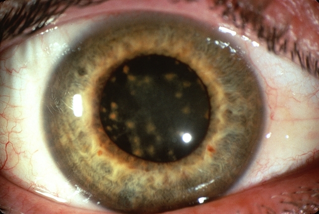 Siderosis