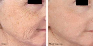 cheeks microneedling-with-prp-before-and-after-300x150.jpeg