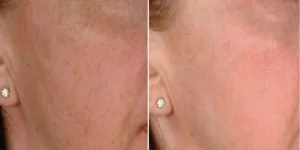 Microneedling-Pigmentation--300x150.jpeg
