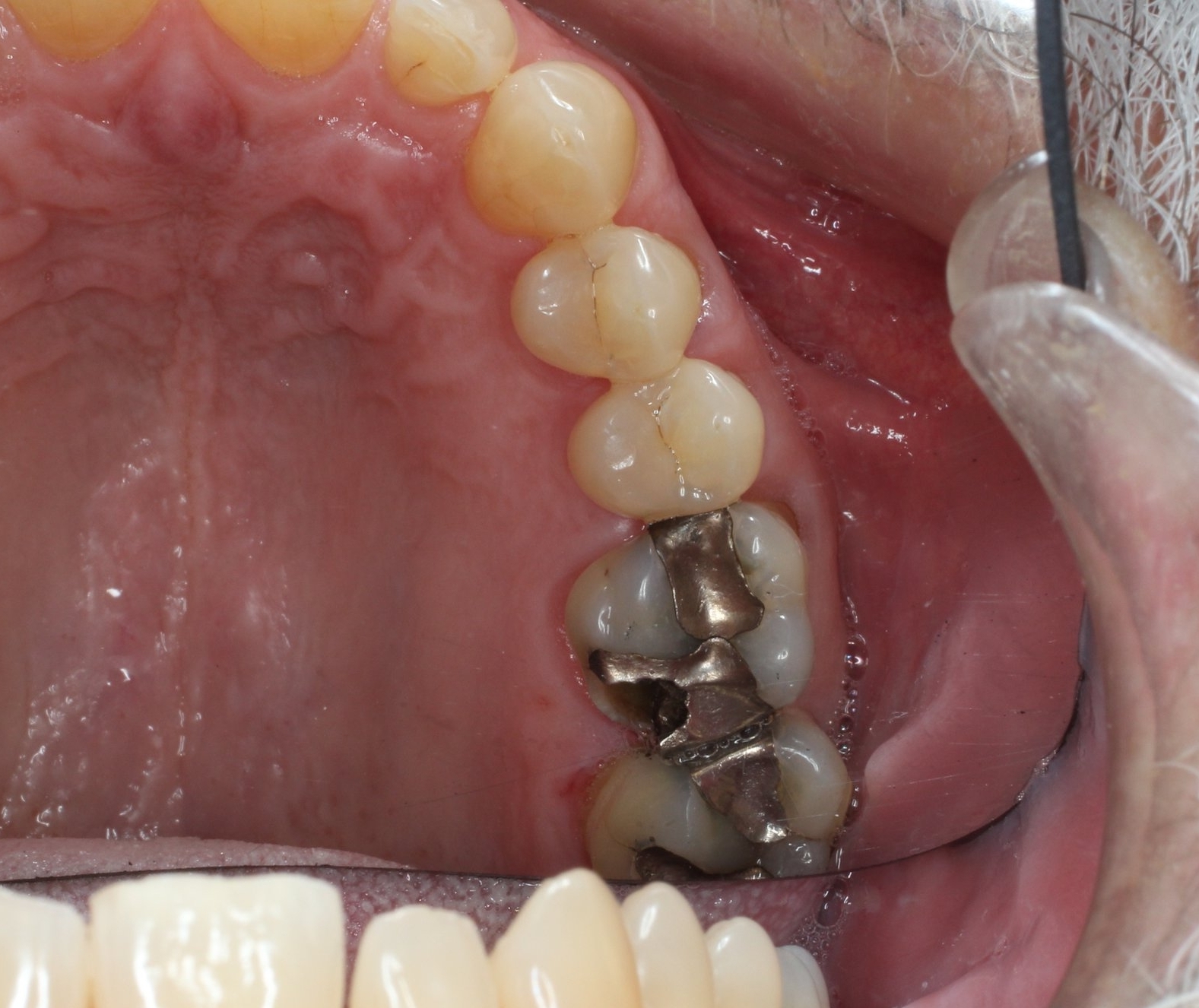 Large mercury filling causing the tooth to fracture