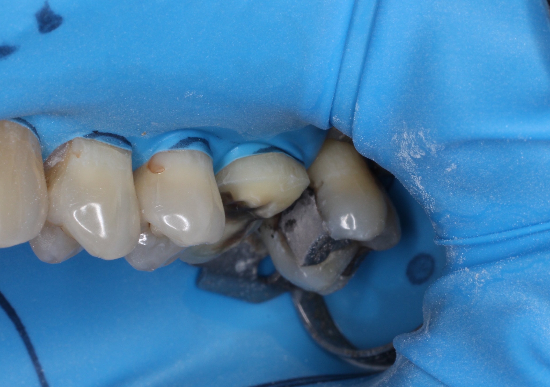 Conservative preparation of the tooth