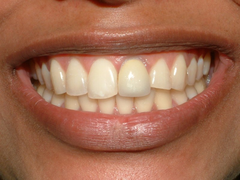 Unaesthetic metal/ceramic crown on the central incisor