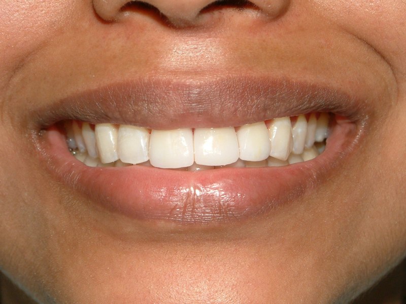 Ceramic veneer and crown on central incisors