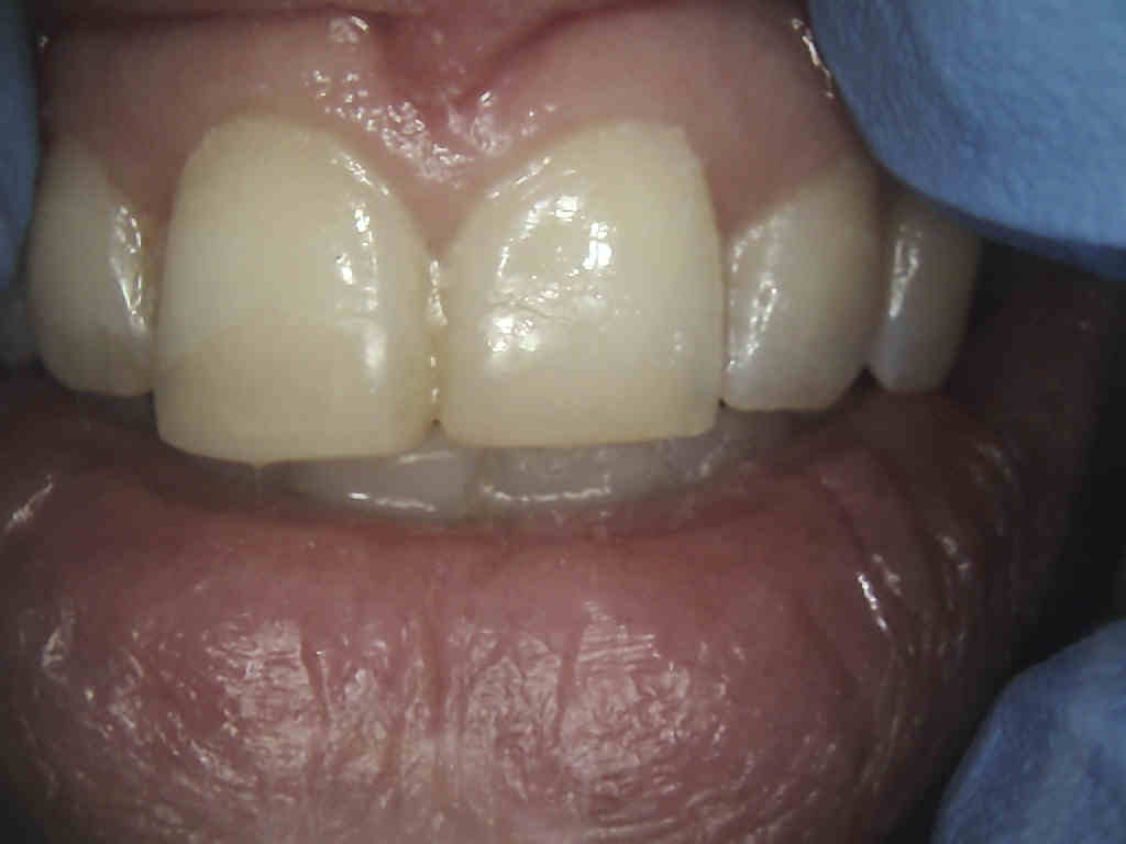 Unaesthetic white fillings on central incisors