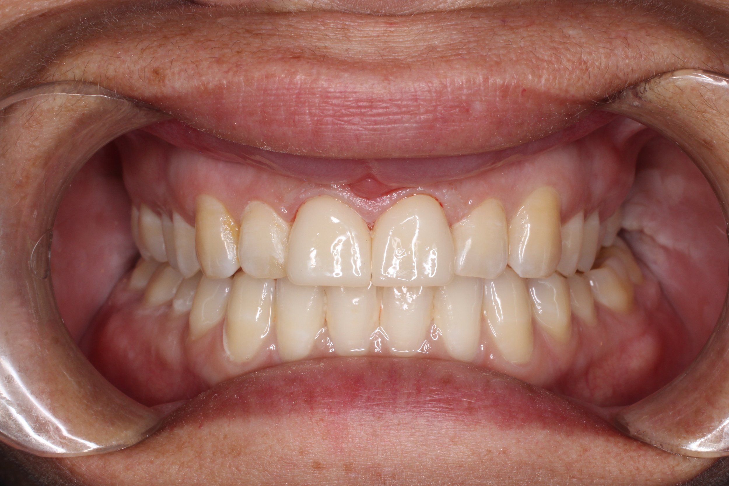 Ceramic crowns on central incisors.  Done in one appointment