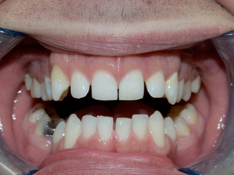 Unaesthetic spacing between teeth