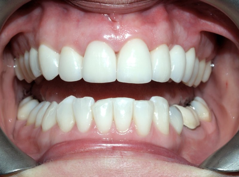 Ceramic restorations on upper teeth, whitening of the lower teeth