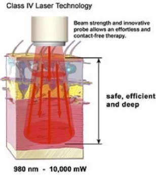 class 4 laser treatment
