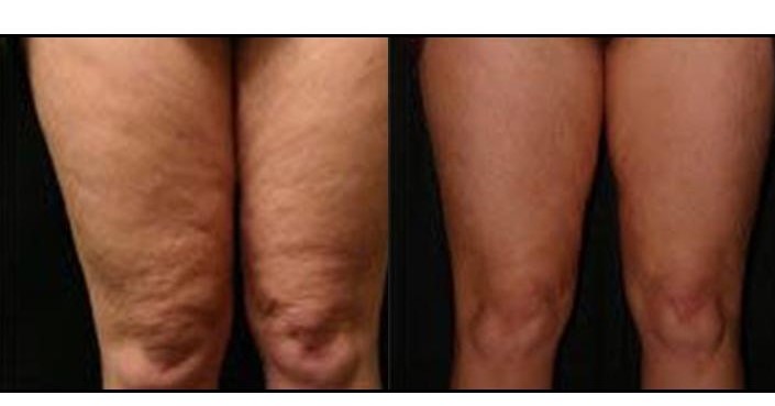 legs before and after lipolaser (3).jpg